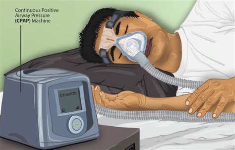 obstructive sleep apnea patient information